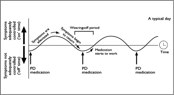 Graph showing medication effect and wearing-off periods in Parkinson’s disease over a typical day - Dr. Mitesh Chandarana