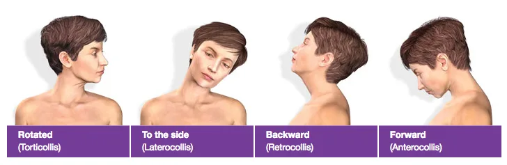 Illustration showing four abnormal head positions in cervical dystonia: rotated, to the side, backward, and forward.