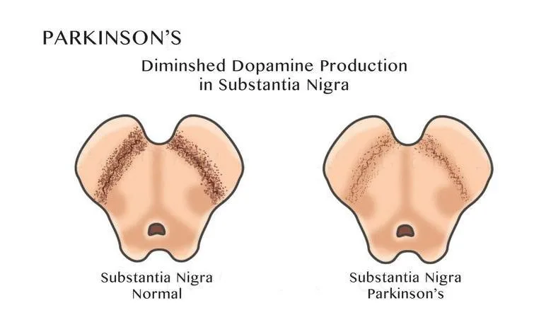 Diminshed Dopamine Production in Substantia Nigra - Movement Disorder Specialist Dr. Mitesh Chandarana