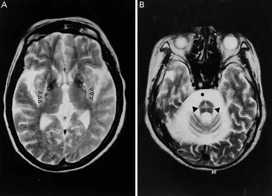 MRI brain scans showing structural changes commonly associated with Multiple System Atrophy, including pontine and basal ganglia abnormalities.