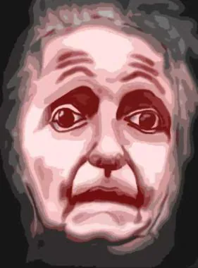 Illustration showing facial stiffness and expression changes in Progressive Supranuclear Palsy (PSP).