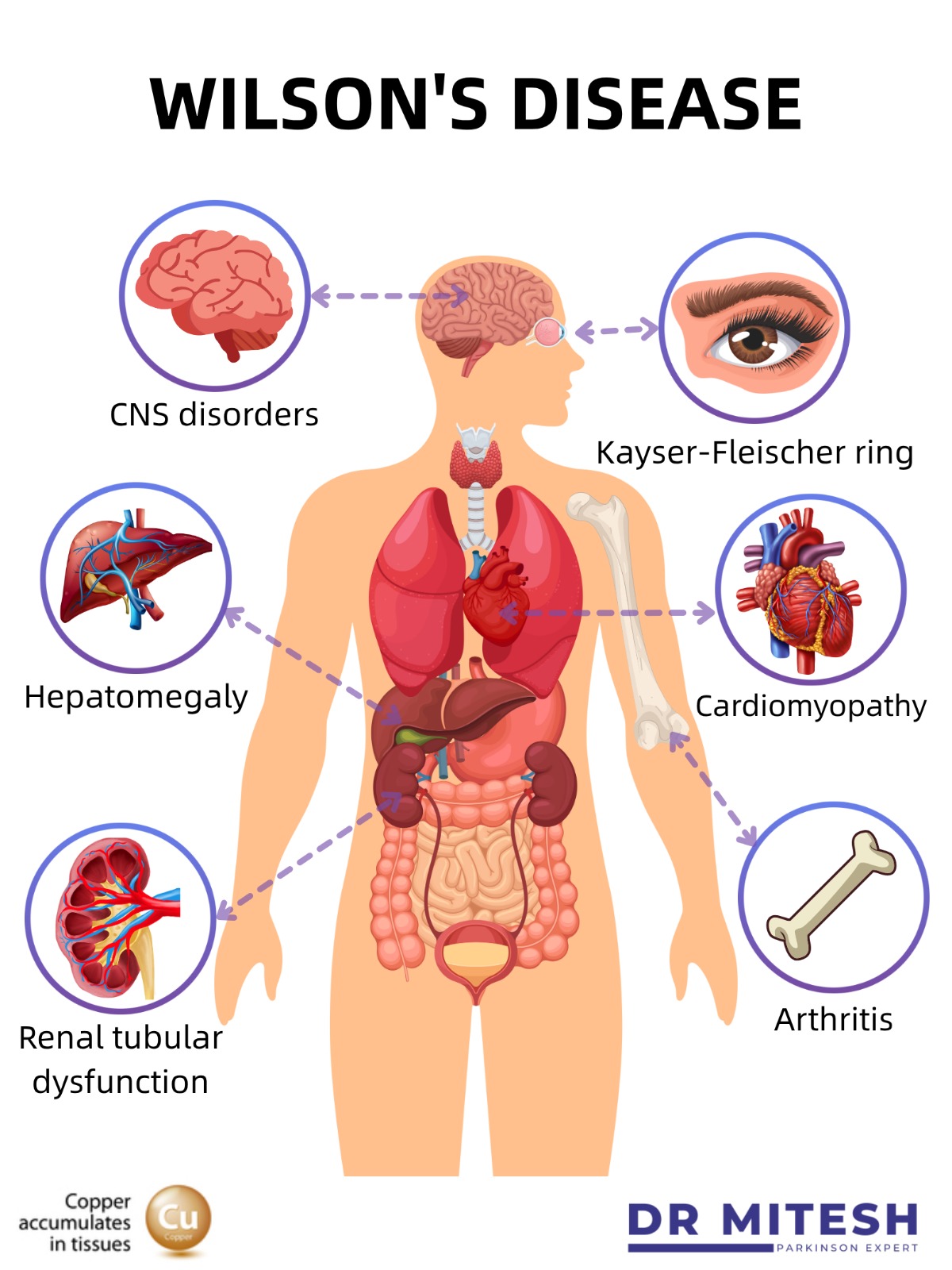 Medical illustration showing body organs affected by Wilson’s Disease, including the brain, liver, kidneys, and eyes due to copper accumulation.
