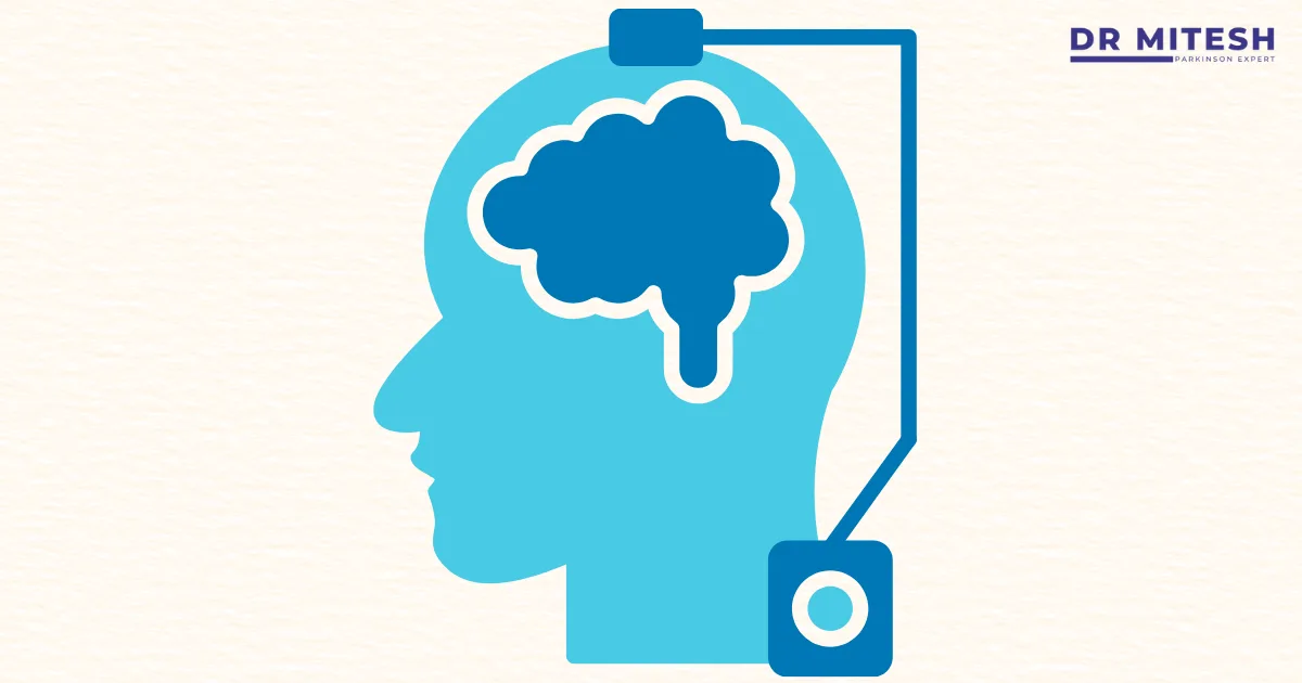 After DBS illustration showing brain stimulation device when Parkinson’s symptoms persist